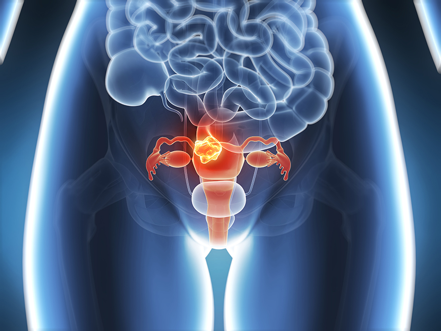 Cancer du col de l’utérus : individualiser et ajuster le traitement grâce à l’évaluation de la réponse en temps réel